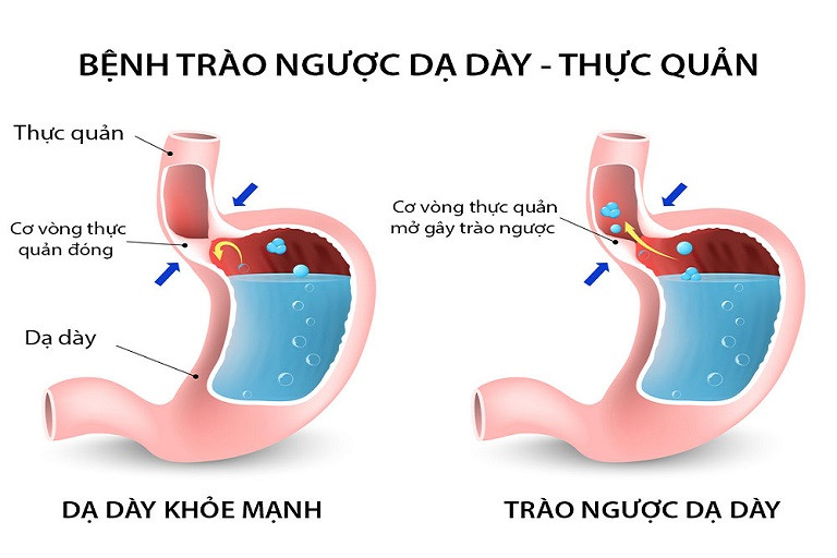 Giấc Ngủ Kém Dài: Nguyên Nhân, Hệ Lụy và Giải Pháp